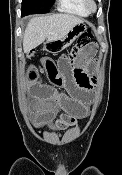 File:Adhesional small bowel obstruction (Radiopaedia 58900-66131 Coronal C+ portal venous phase 86).jpg