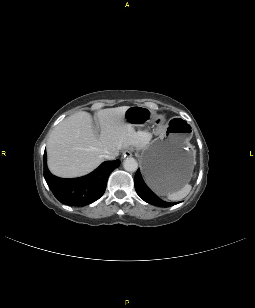 Adhesional small bowel obstruction (Radiopaedia 85402-101024 Axial C+ portal venous phase 43).jpg