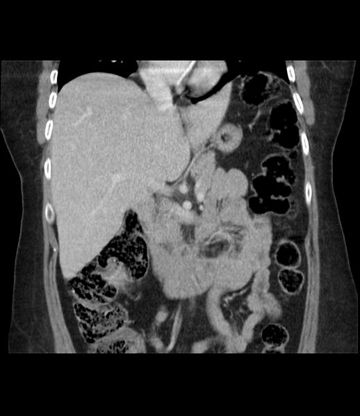 File:Adrenal cortical carcinoma with IVC invasion and thrombosis (Radiopaedia 34307-35597 Coronal C+ portal venous phase 25).jpg