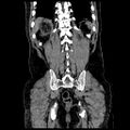Adrenal myelolipoma (Radiopaedia 41843-44834 Coronal non-contrast 21).jpg