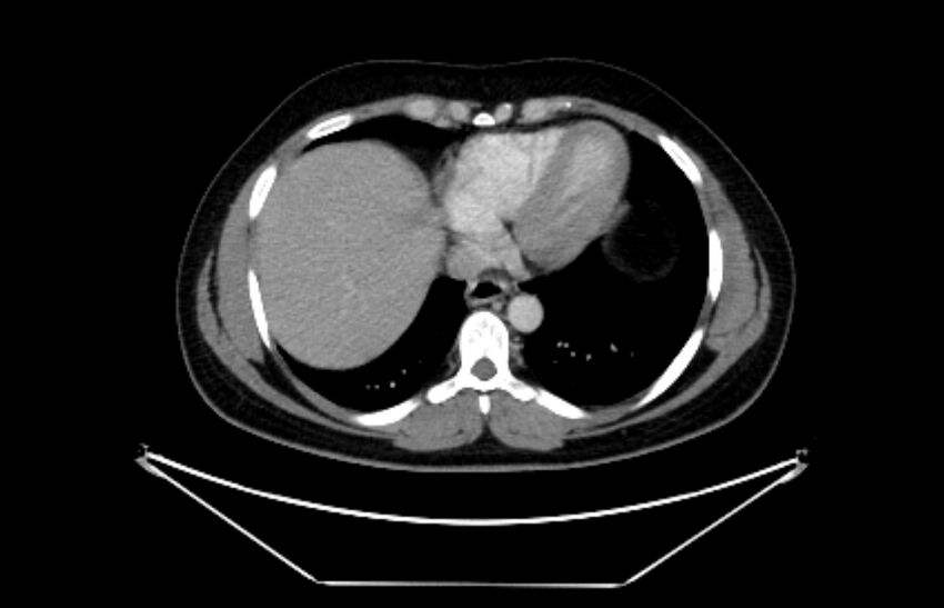 Adrenocortical carcinoma (Radiopaedia 80134-93438 Axial C+ portal venous phase 15).jpg