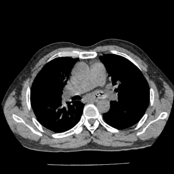 File:Airway foreign body in adult (Radiopaedia 85907-101779 Axial liver window 69).jpg