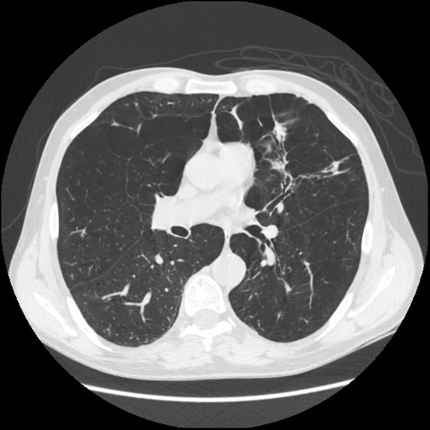 Alpha-1-antitrypsin deficiency (Radiopaedia 40993-43722 Axial lung window 117).jpg
