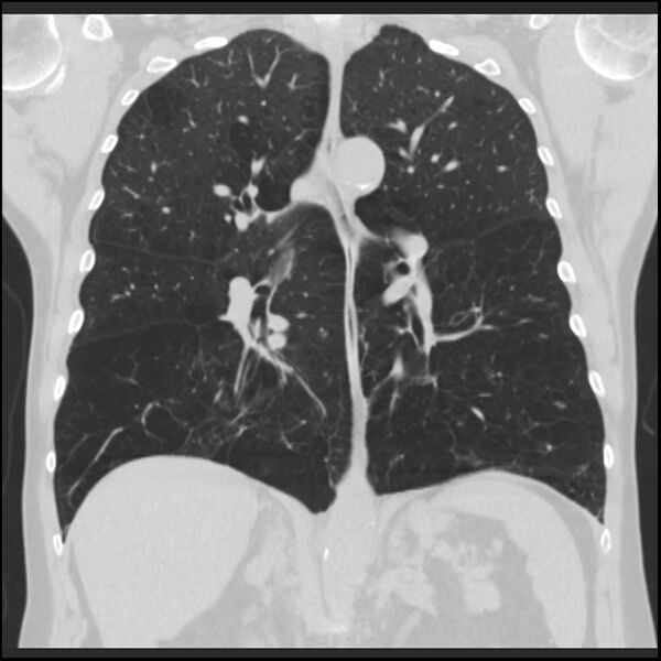 File:Alpha-1-antitrypsin deficiency (Radiopaedia 40993-43722 Coronal lung window 59).jpg