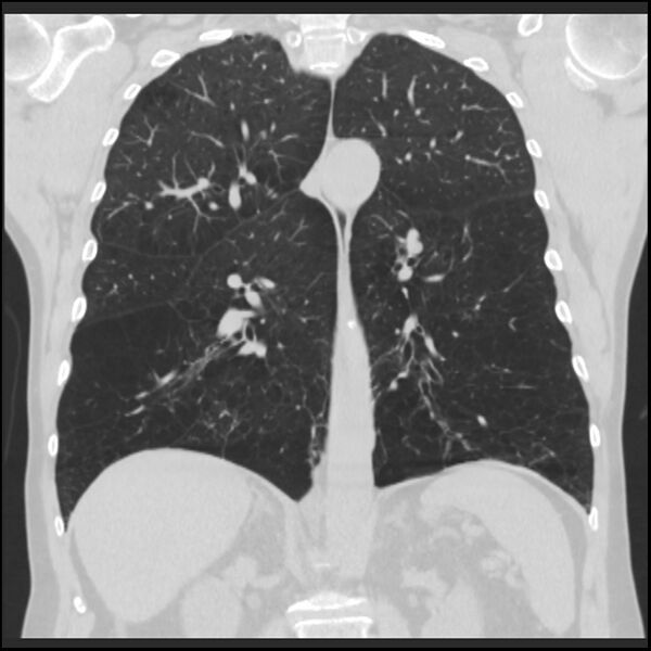 File:Alpha-1-antitrypsin deficiency (Radiopaedia 40993-43722 Coronal lung window 63).jpg