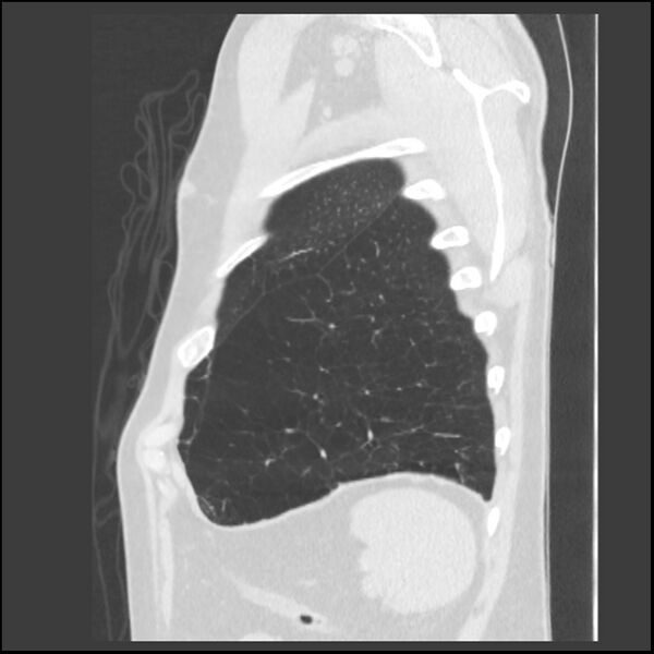 File:Alpha-1-antitrypsin deficiency (Radiopaedia 40993-43722 Sagittal lung window 36).jpg