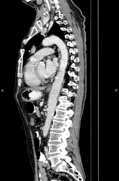 File:Ampullary adenocarcinoma (Radiopaedia 86093-102033 E 53).jpg