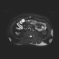Ampullary tumor (Radiopaedia 27294-27479 T2 SPAIR 2).jpg