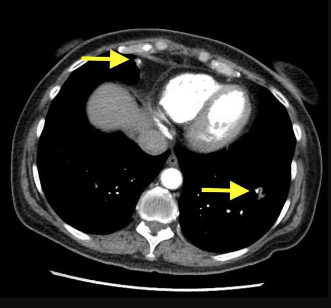 File:Amyloidosis - bronchial and diffuse nodular pulmonary involvement (Radiopaedia 60156-68457 B 1).png