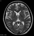 Amyotrophic lateral sclerosis (Radiopaedia 5373-7134 Axial T2 13).jpg