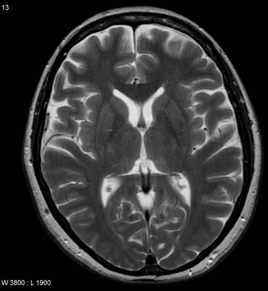 File:Amyotrophic lateral sclerosis (Radiopaedia 5373-7134 Axial T2 13).jpg