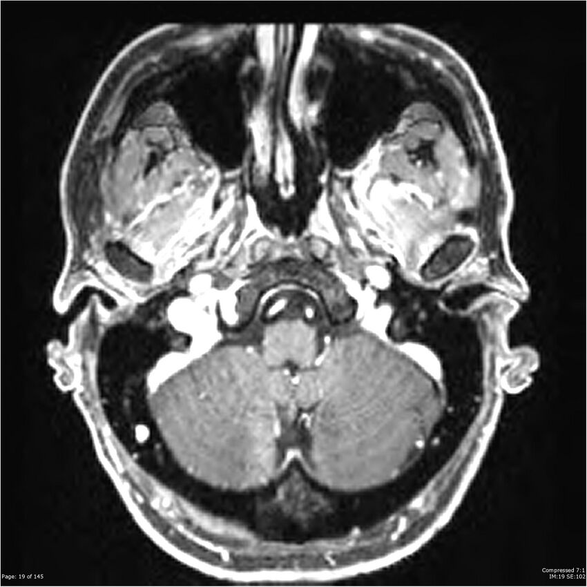 Anaplastic meningioma with recurrence (Radiopaedia 34452-35788 Axial T1 C+ 19).jpg
