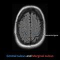 Anatomy- sulci of the brain (Radiopaedia 33834-34995 B 3).jpg