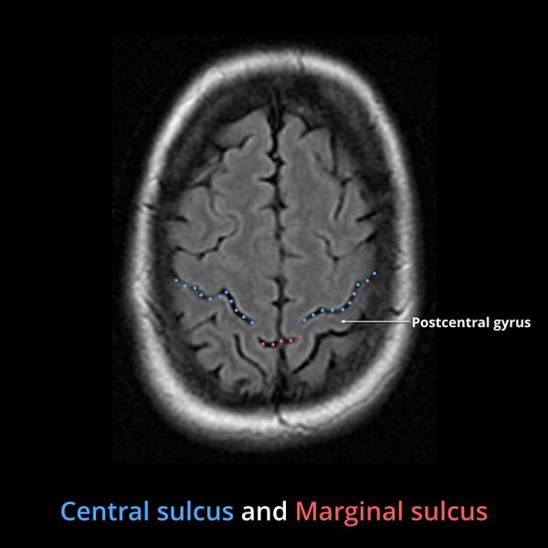 File:Anatomy- sulci of the brain (Radiopaedia 33834-34995 B 3).jpg