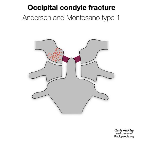 File:Anderson and Montesano classification of occipital condyle fractures (diagrams) (Radiopaedia 87203-103478 types 1).jpeg