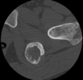 Aneurysmal bone cyst of ischium (Radiopaedia 25957-26094 B 28).png