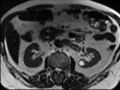 Annular pancreas (Radiopaedia 38292-40320 B 23).png