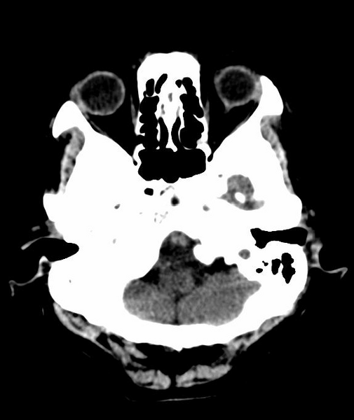 File:Anomalous intracranial venous drainage (Radiopaedia 28161-28418 Axial 53).png