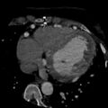 Anomalous left coronary artery from the pulmonary artery (ALCAPA) (Radiopaedia 40884-43586 A 58).jpg