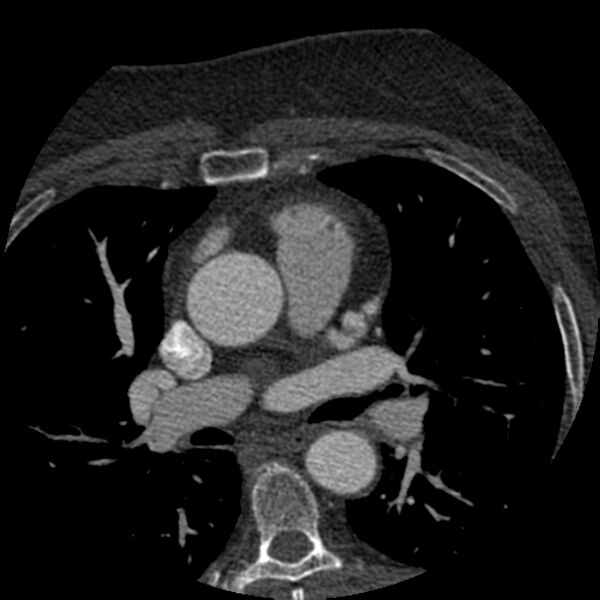 File:Anomalous origin of left circumflex artery from right coronary sinus (Radiopaedia 72563-83117 B 22).jpg
