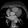 Anomalous origin of left circumflex artery from right coronary sinus (Radiopaedia 72563-83117 B 52).jpg