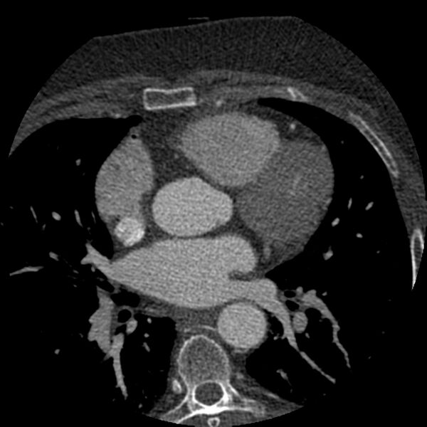 File:Anomalous origin of left circumflex artery from right coronary sinus (Radiopaedia 72563-83117 B 52).jpg