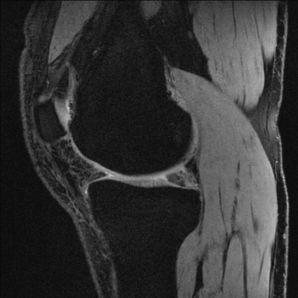 File:Anterior cruciate ligament mucoid degeneration (Radiopaedia 68400-77933 Sagittal 42).jpg