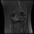 Anterior cruciate ligament tear, Wrisberg rip and bucket-handle tear of medial meniscus (Radiopaedia 75872-87266 Coronal PD fat sat 21).jpg
