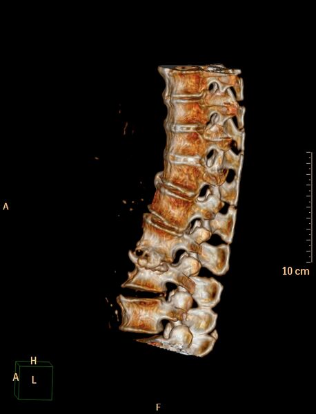 File:Anterior vertebral scalloping (abdominal aortic aneurysm) (Radiopaedia 66744-76067 A 1).jpg
