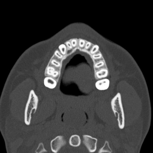 File:Antrochoanal polyp (Radiopaedia 21894-21868 Axial bone window 4).jpg