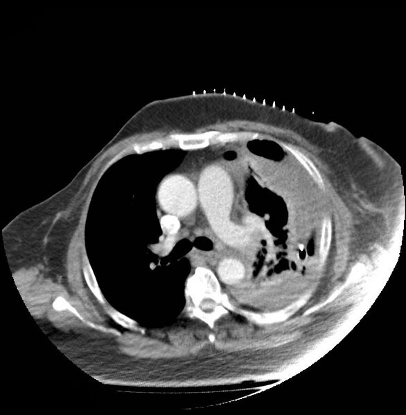File:Aortic arch false aneurysm (Radiopaedia 14667-14588 A 11).jpg