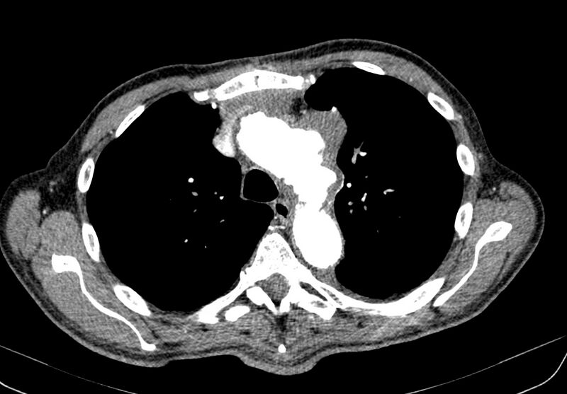 File:Aortic arch saccular aneurysm (Radiopaedia 19430-19457 B 3).jpg