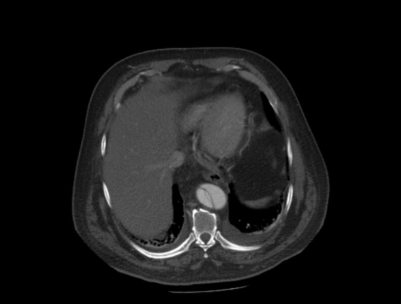 File:Aortic dissection (Radiopaedia 28802-29105 A 33).jpg