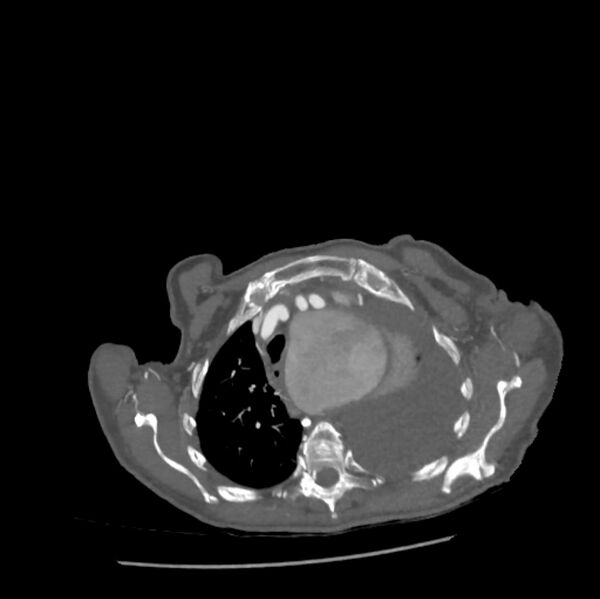 File:Aortic dissection (Radiopaedia 68763-78691 A 6).jpeg