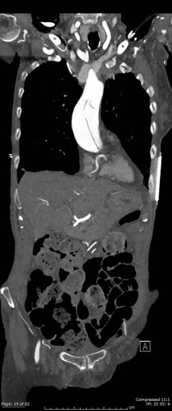 File:Aortic dissection with extension into aortic arch branches (Radiopaedia 64402-73204 A 19).jpg