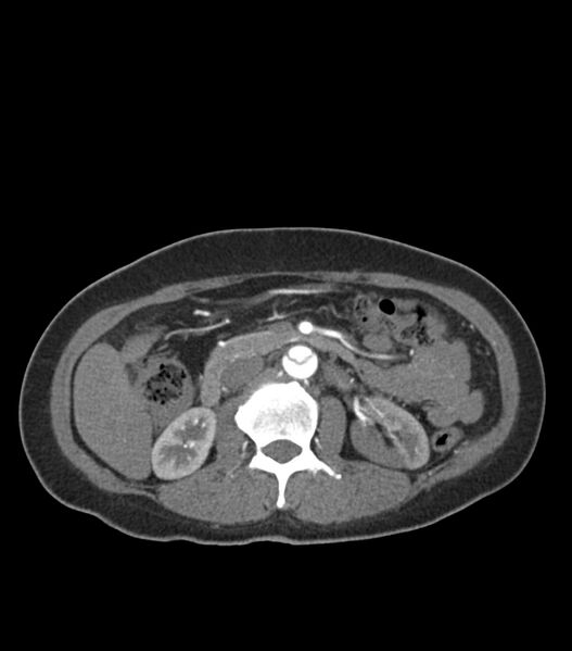 File:Aortic dissection with renal ischemia (Radiopaedia 76573-88338 A 73).jpg