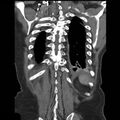Aortic dissection with rupture into pericardium (Radiopaedia 12384-12647 B 39).jpg