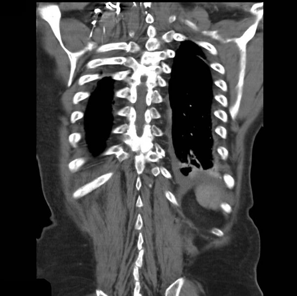 File:Aortic dissection with rupture into pericardium (Radiopaedia 12384-12647 B 39).jpg