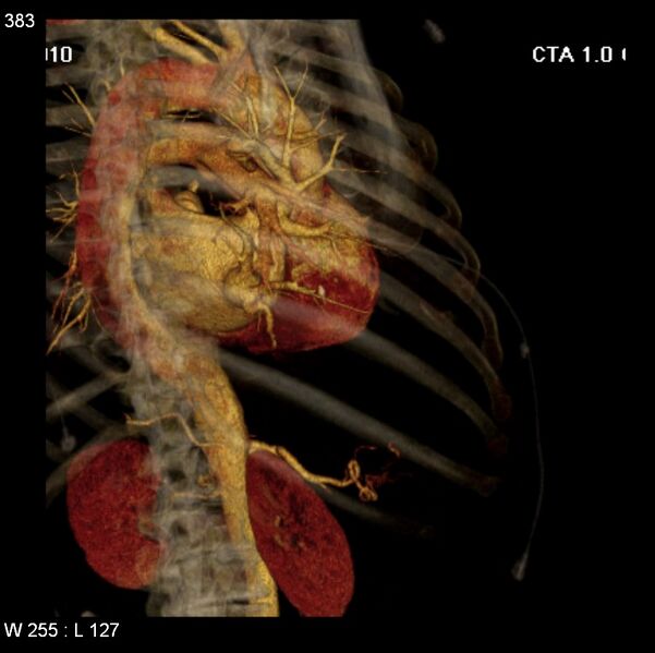 File:Aortic dissection with rupture into pericardium (Radiopaedia 12384-12647 C+ arterial phase 15).jpg