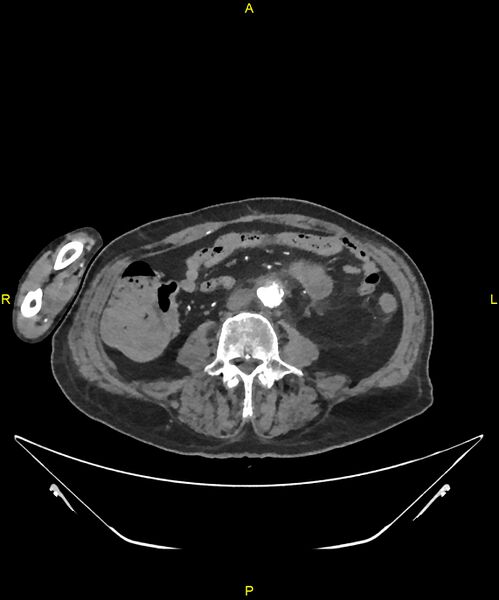 File:Aortoenteric fistula (Radiopaedia 84308-99603 B 217).jpg