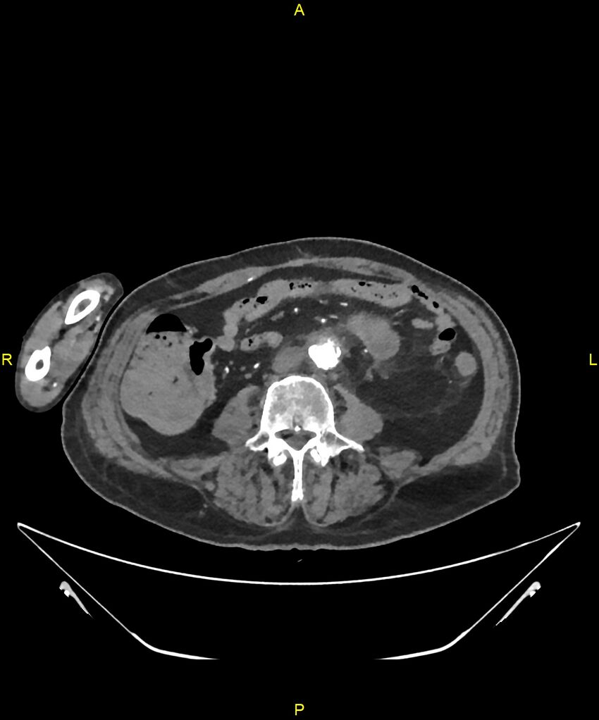 Aortoenteric fistula (Radiopaedia 84308-99603 B 217).jpg