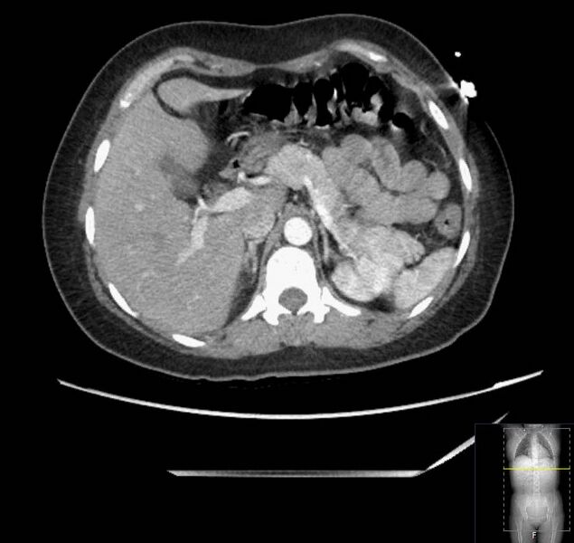 File:Appendicitis (CT angiogram) (Radiopaedia 154713-127660 Axial 150).jpg
