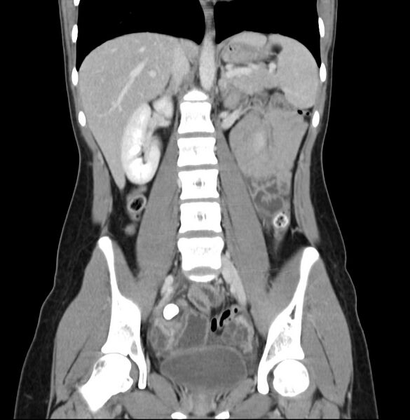 File:Appendicitis and incidental bicornuate uterus (Radiopaedia 22833-22853 D 24).jpg