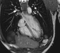 Arrhythmogenic right ventricular cardiomyopathy (Radiopaedia 39806-42237 D 134).jpg