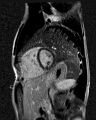 Arrhythmogenic right ventricular cardiomyopathy (Radiopaedia 57972-64966 D 8).jpg