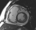 Arrhythmogenic right ventricular cardiomyopathy (Radiopaedia 69431-79307 Short axis cine 145).jpg