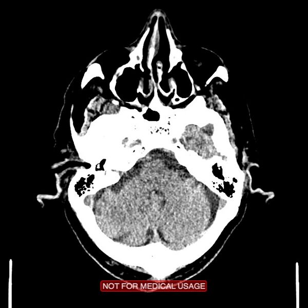 File:Artery of Percheron infarction (Radiopaedia 28679-28967 Axial non-contrast 28).jpg