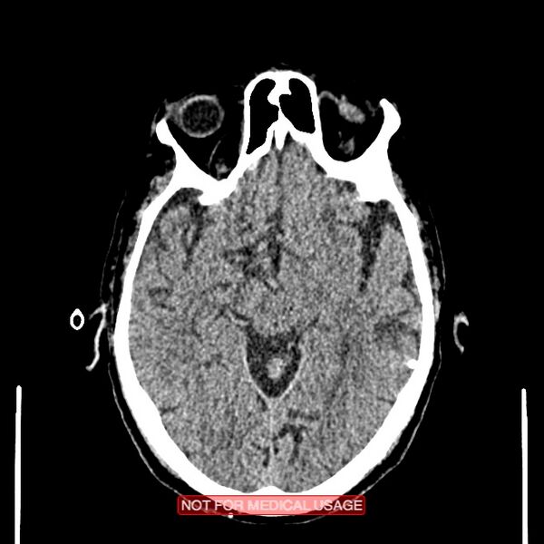 File:Artery of Percheron infarction (Radiopaedia 28679-28967 Axial non-contrast 51).jpg