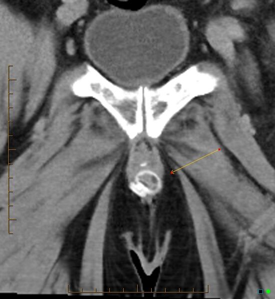 File:Artificial urethral sphincter (Radiopaedia 46937-51464 B 1).jpg