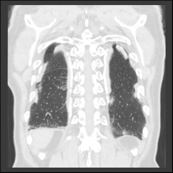 File:Asbestos-related pleural plaques (Radiopaedia 39069-41255 Coronal lung window 13).jpg